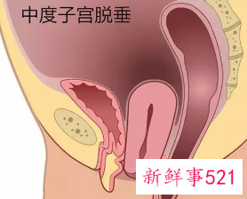 女性子宫脱垂是什么造成的