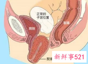 女性子宫脱垂是什么造成的