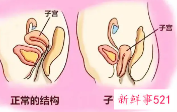 女性子宫脱垂是什么造成的