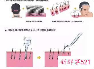 毛发移植是什么原理