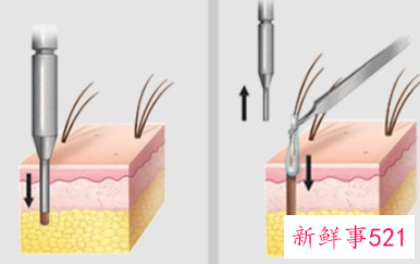 毛发移植是什么原理